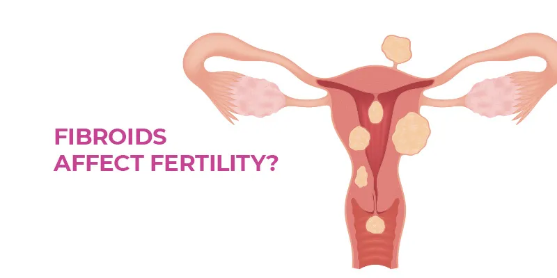 How to Protect Your Fertility from Fibroids